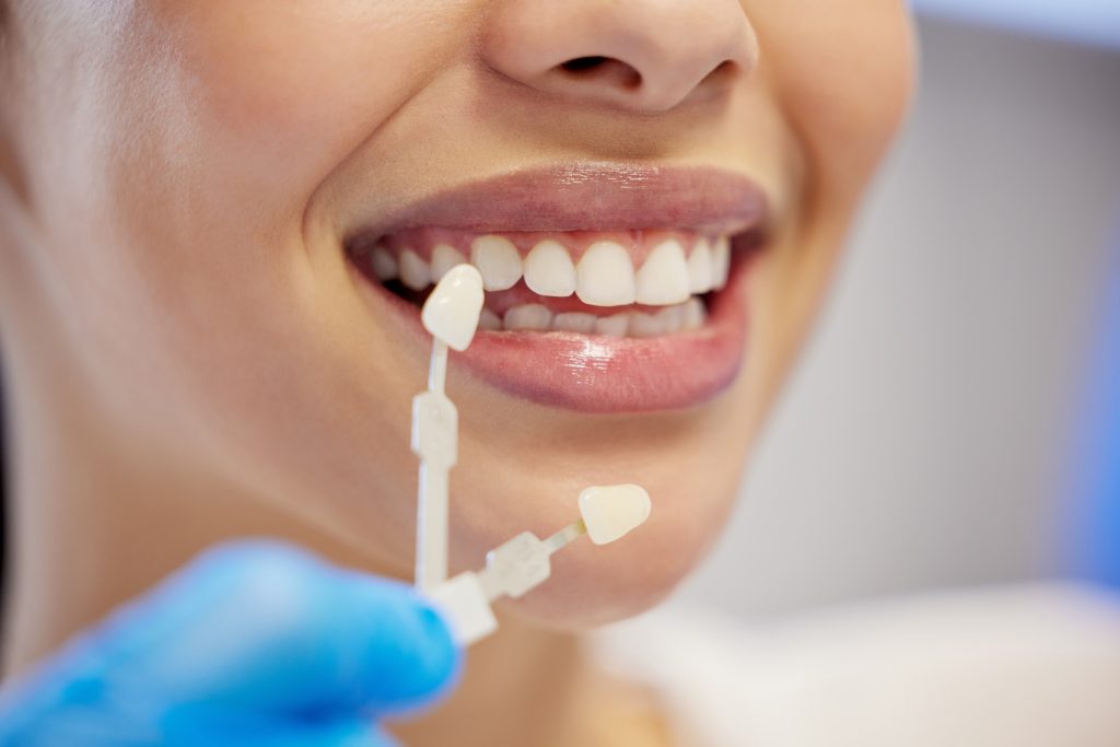 Beautiful woman shows her porcelain venners at dentist