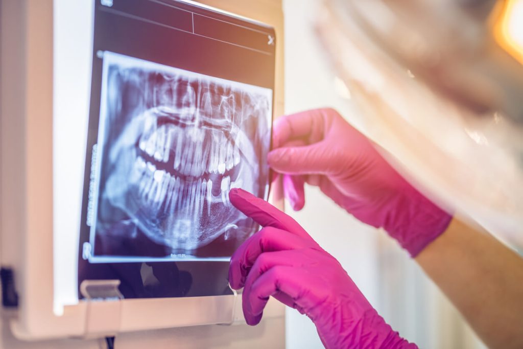 how many dental x-rays are safe in a month