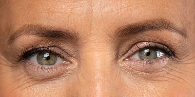 Botox for Cosmetics