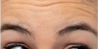 Botox for Cosmetics