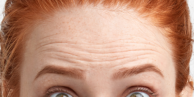 Botox for Cosmetics