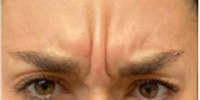 Botox for Cosmetics