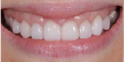 Botox for Cosmetics