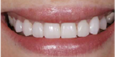 Botox for Cosmetics