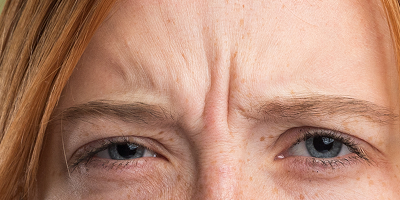 Botox for Cosmetics