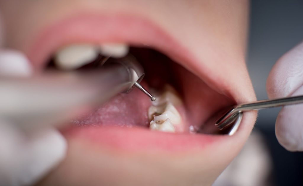 Cavity Teeth