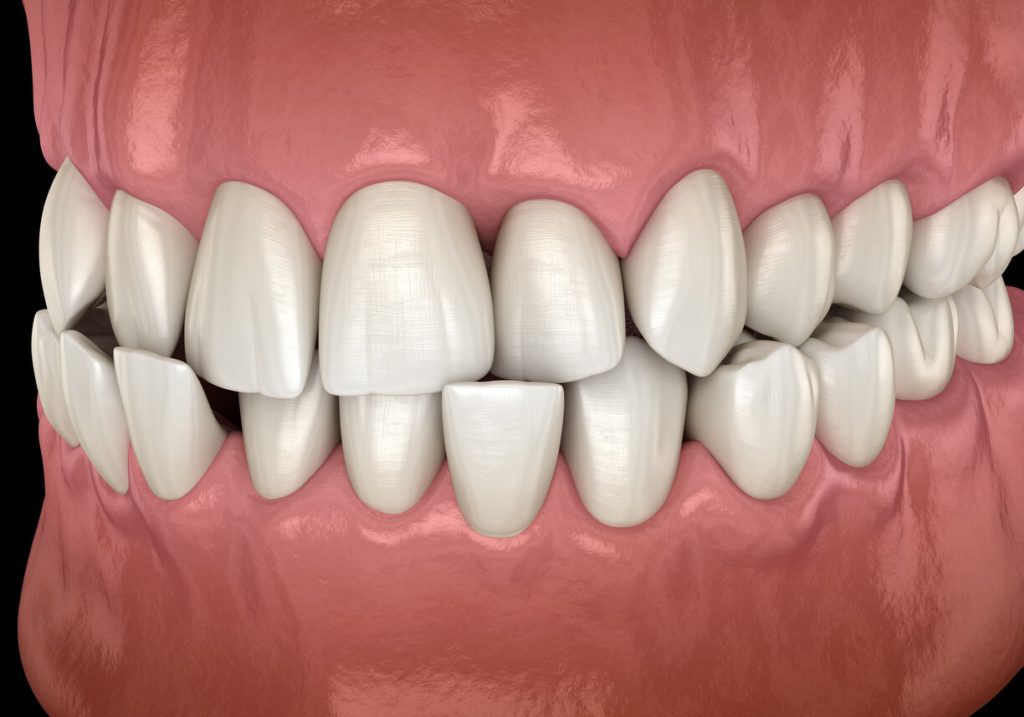bite misalignment symptoms